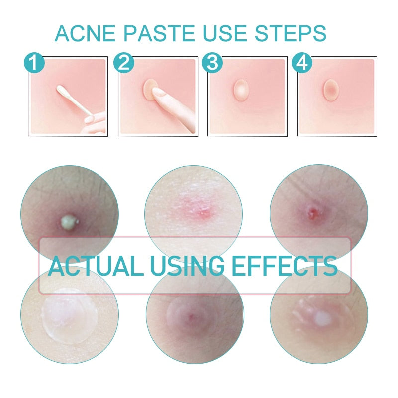 Skin Tag Remover Patch (BIG PATCH 108 pcs)